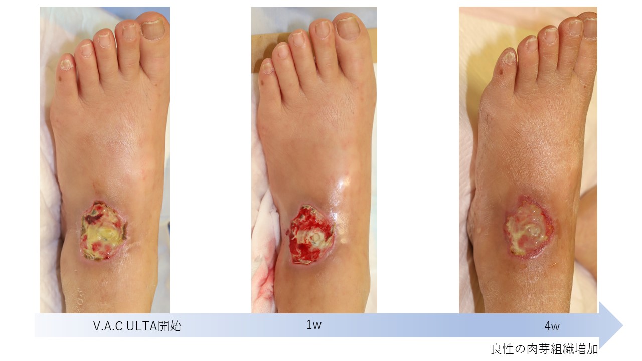 形成外科】糖尿病性足潰瘍、重症下肢虚血治療の解説：第1回 創傷治療 | 熊本市中央区のサキサカ病院
