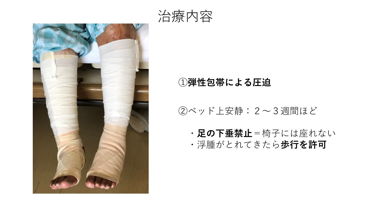 形成外科】 静脈うっ帯性潰瘍の治療 | 熊本市中央区のサキサカ病院